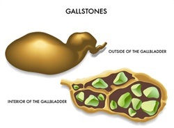 Gallstones Treatment London Gallbladder Surgery London